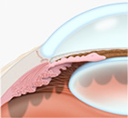 Glaucoma Treatment Red Bank NJ