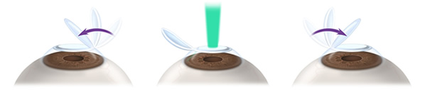 LASIK | PRK Surgery Red Bank NJ