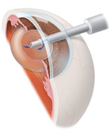Cataract Surgery | IOLs Red Bank NJ